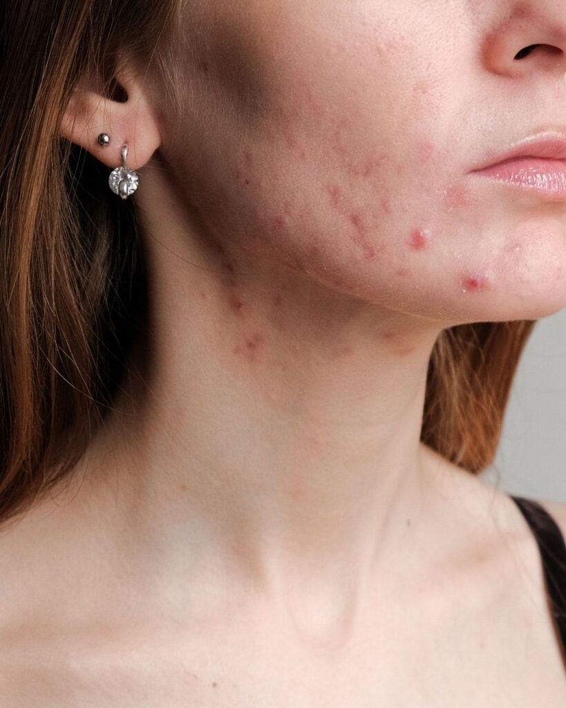 Acne