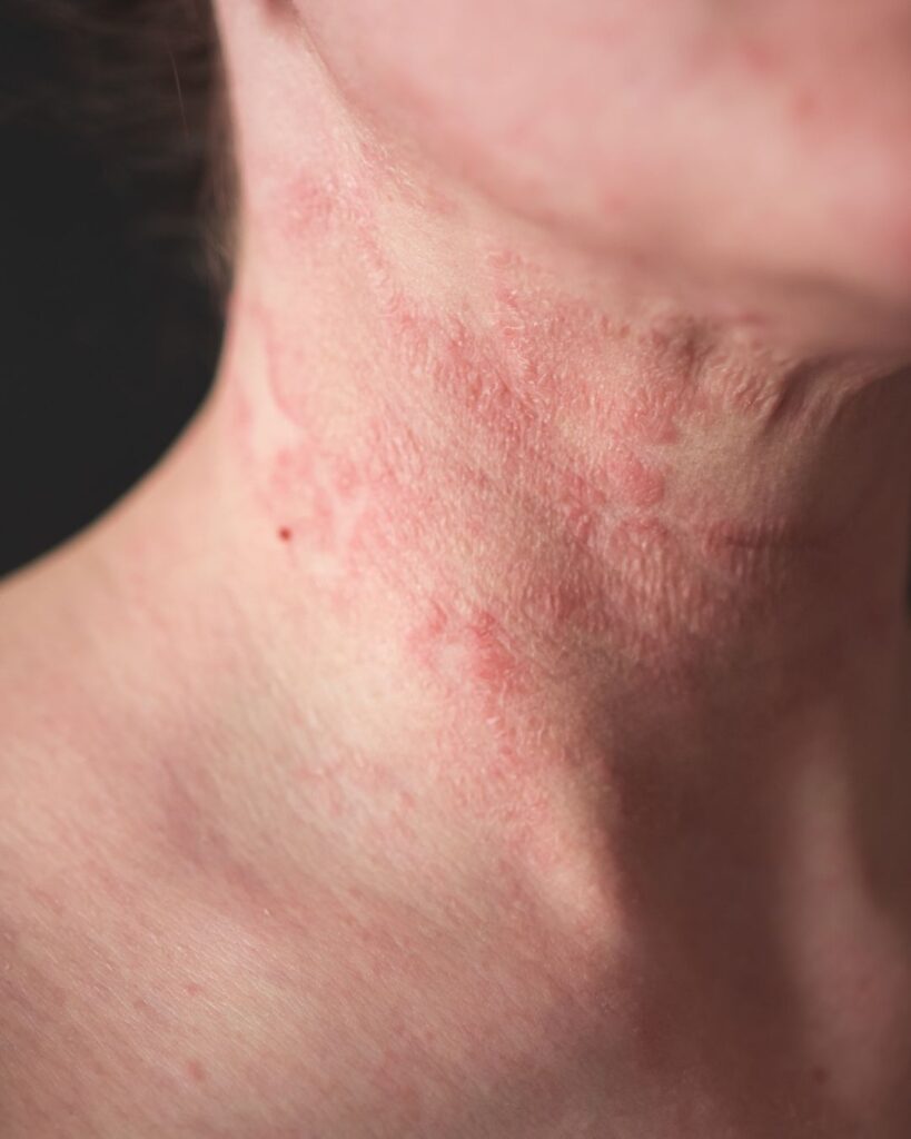 Dermatites
