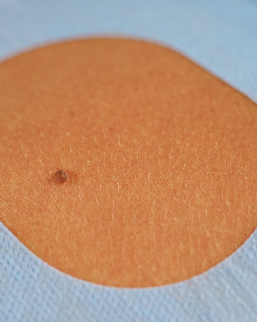 Cirurgia Dermatológica